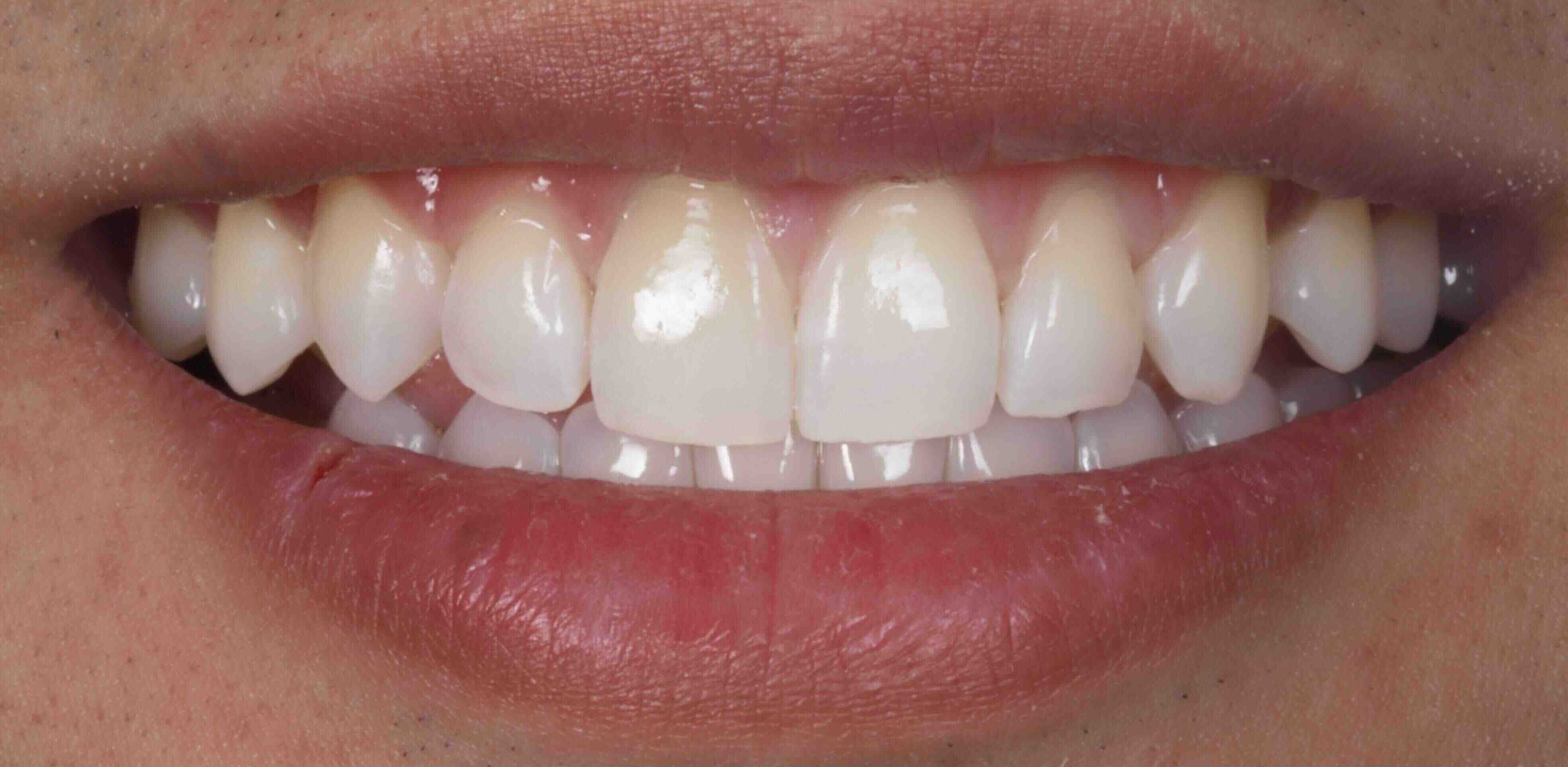 Invisalign and whitening transformation